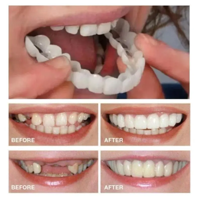 2pcs Comfortable And Flexible White Denture Veneers With Upper And Lower Denture Accessories, Unisex, Easy-to-Wear Dental Accessories - The Ultimate Denture Veneer Solution To Boost Your Confidence Oral 0