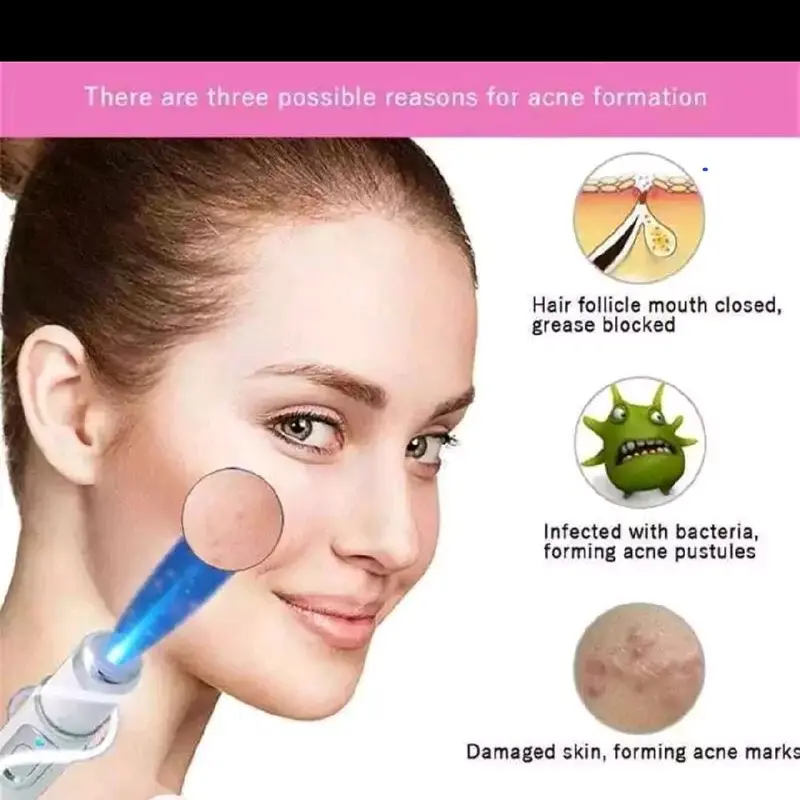 Skinfulgloww Light Therapy Laser Treatment Pen for Acne Scar and Wrinkle Reduction - Electrical, Comfort, Gentle 2