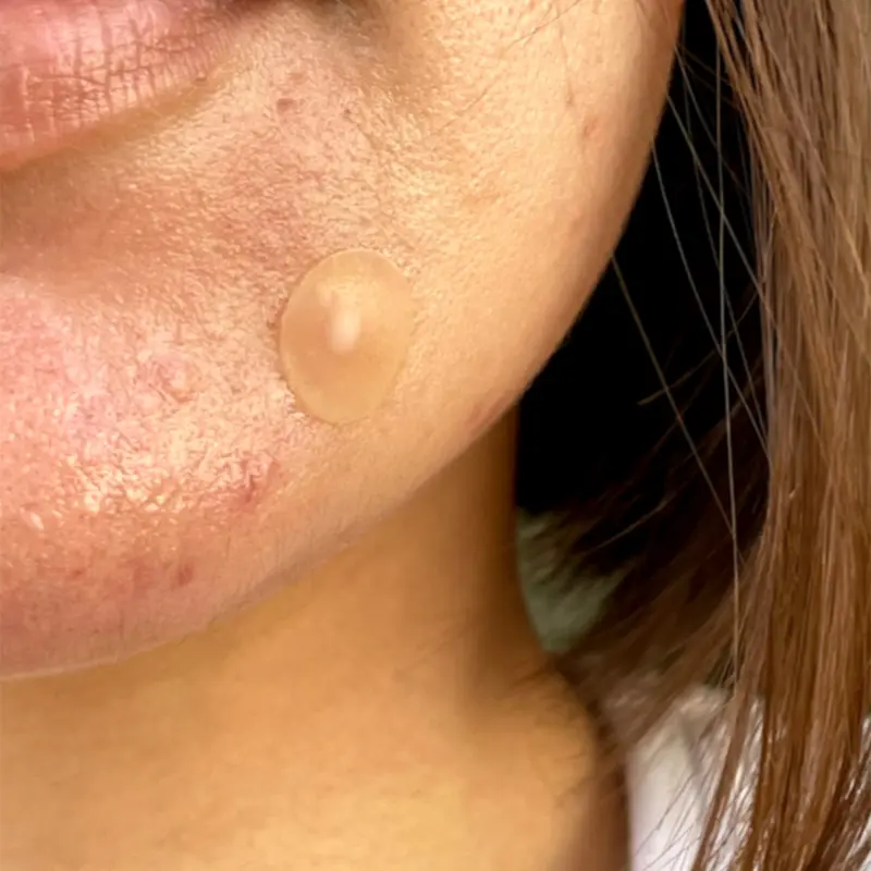 Peace Out Jumbo Acne Dots (40 Dots) - Acne Treatments 2